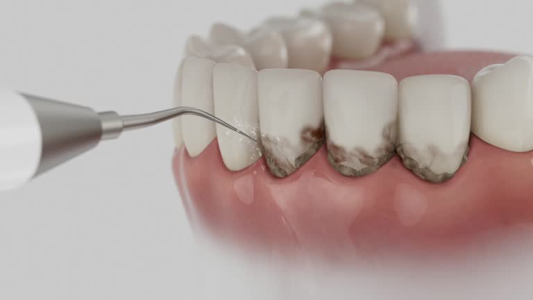 Trusted Wisdom Tooth Removal service in Winter Springs, FL - Dentist Open Now